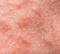 Eczema atopic dermatitis Royalty Free Stock Photo