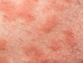 Eczema atopic dermatitis Royalty Free Stock Photo