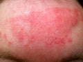 Eczema