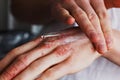 Eczema on the hands. The man applying the ointment , creams in the treatment of eczema, psoriasis and other skin Royalty Free Stock Photo