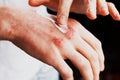 Eczema on the hands. The man applying the ointment , creams in the treatment of eczema, psoriasis and other skin Royalty Free Stock Photo