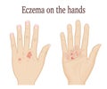 Eczema on the hands