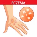 Eczema of the Hands psoriasis, dermatitis, dermatology, eczema, skin, treatment, Royalty Free Stock Photo