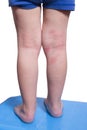 Eczema on the kid's legs Royalty Free Stock Photo