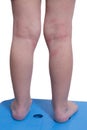 Eczema on the kid's legs Royalty Free Stock Photo