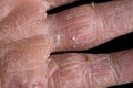 Eczema with redness, swellings, bumps and flakes on the hand and fingers Royalty Free Stock Photo