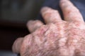 Eczema with redness, swellings, bumps and flakes on the hand and fingers