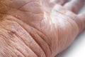 Eczema with redness, swellings, bumps and flakes on the hand and fingers Royalty Free Stock Photo