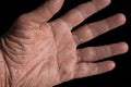 Eczema with redness, swellings, bumps and flakes on the hand and fingers Royalty Free Stock Photo