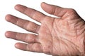 Eczema with redness, swellings, bumps and flakes on the hand and fingers Royalty Free Stock Photo