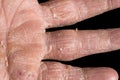 Eczema with redness, swellings, bumps and flakes on the hand and fingers Royalty Free Stock Photo