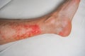 Eczema Skin disease on the legs, itchy red rashes and spots Royalty Free Stock Photo