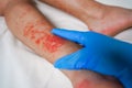 Eczema Skin disease on the legs, itchy red rashes and spots Royalty Free Stock Photo