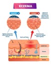 Eczema vector illustration. Labeled anatomical structure comparative scheme Royalty Free Stock Photo