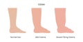 Edema of feet