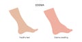 Edema of feet