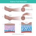 Edema Fluid Retention. Dents on skin