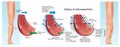 Edema medical illustration