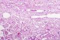 Edema of renal tubular epithelial cells in kidney failure