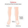 Edema. Swollen ankles, feet and legs. oedema Royalty Free Stock Photo