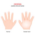 Edema. Swollen arms and hands. oedema