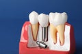 Educational model of gum with dental implant between teeth on blue background, closeup