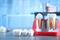 Educational model with post of dental implant between teeth and crowns on table indoors Royalty Free Stock Photo