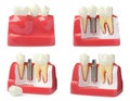 Educational models of gum with dental implant between teeth on white background, collage Royalty Free Stock Photo