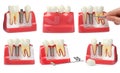 Educational models of gum with dental implant between teeth on white background, collage Royalty Free Stock Photo