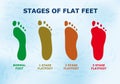 Educational poster about flat feet, different stages of the disease