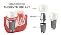 Educational poster showing a structure of the dental implant. Vector illustration isolated on the white background. Royalty Free Stock Photo