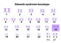 Edwards syndrome karyotype Royalty Free Stock Photo