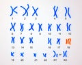 Edwards-syndrome karyotype