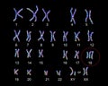 Edwards-syndrome karyotype Royalty Free Stock Photo