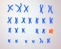 Edwards-syndrome karyotype Royalty Free Stock Photo