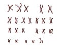 Edwards-syndrome karyotype Royalty Free Stock Photo