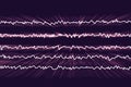 EEG Electroencephalogram, brain wave in awake state with mental activity