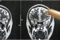 EEG x-ray skulls