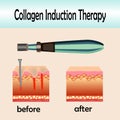 Before after effect, Microneedle stamping device, Collagen induction therapy Royalty Free Stock Photo