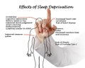 Effects of Sleep Deprivation Royalty Free Stock Photo