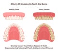 Effects of smoking on teeth and gums. Oral cavity of heavy smoker