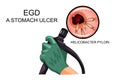 EGD, diagnosis of gastric ulcer