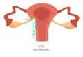 Egg retrieval stage in vitro fertilization artificial insemination