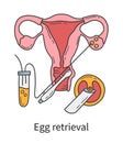 Egg retrieval and transvaginal oocyte extraction from ovaries, In Vitro fertilization