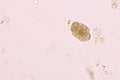 Eggs of Hookworm in human stool