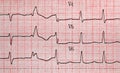 EKG Royalty Free Stock Photo