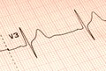 EKG