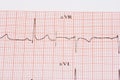 EKG chart Royalty Free Stock Photo