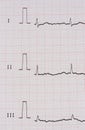 Ekg/ ecg - medical background Royalty Free Stock Photo