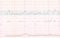 EKG or ECG result Royalty Free Stock Photo